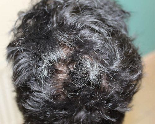 The result of one of our hair transplantation treatments