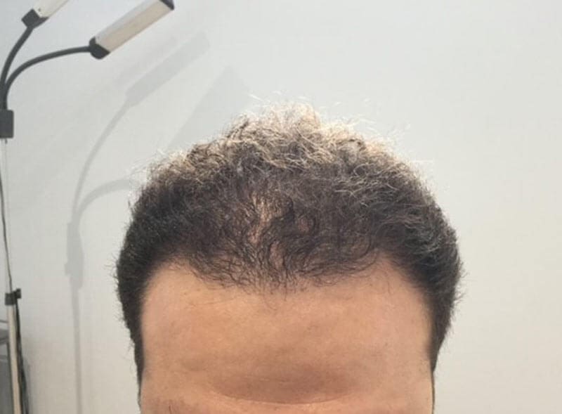 Hair Transplant After