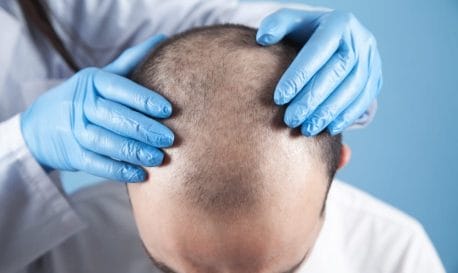 هل عملية زراعة الشعر مؤلمة؟