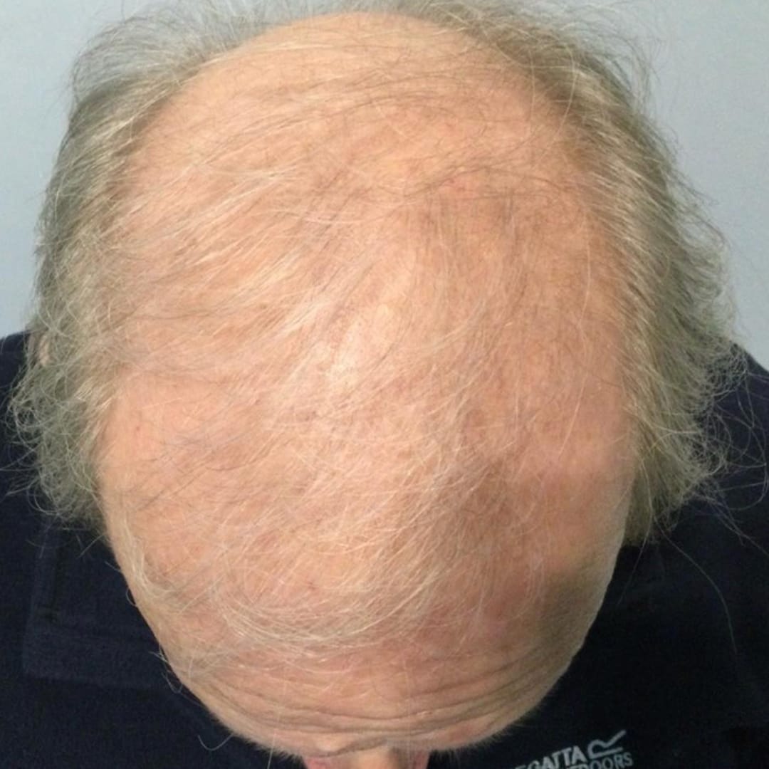 2 days Hair transplant surgery , results after 9 months
