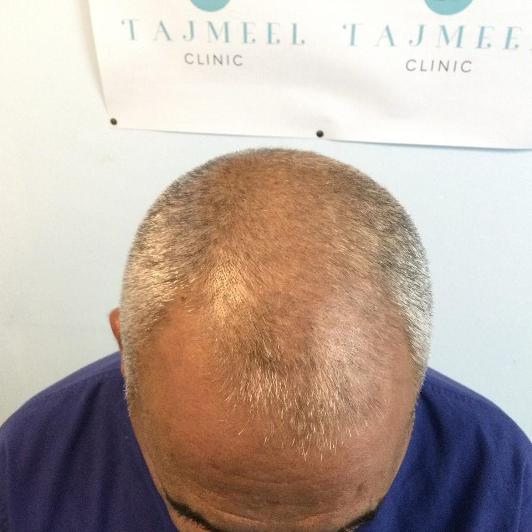 Hair transplant scalp , results after 10 months