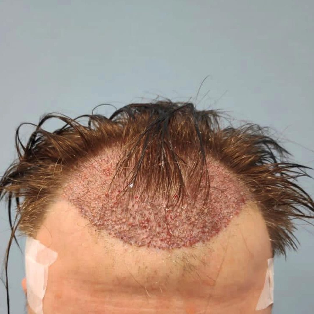 Frontal area and the temples hair transplant, results after 6months