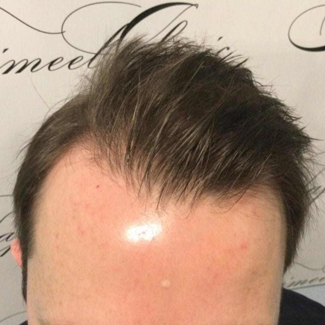 Hair transplant frontal and temples areas, results after 6 months