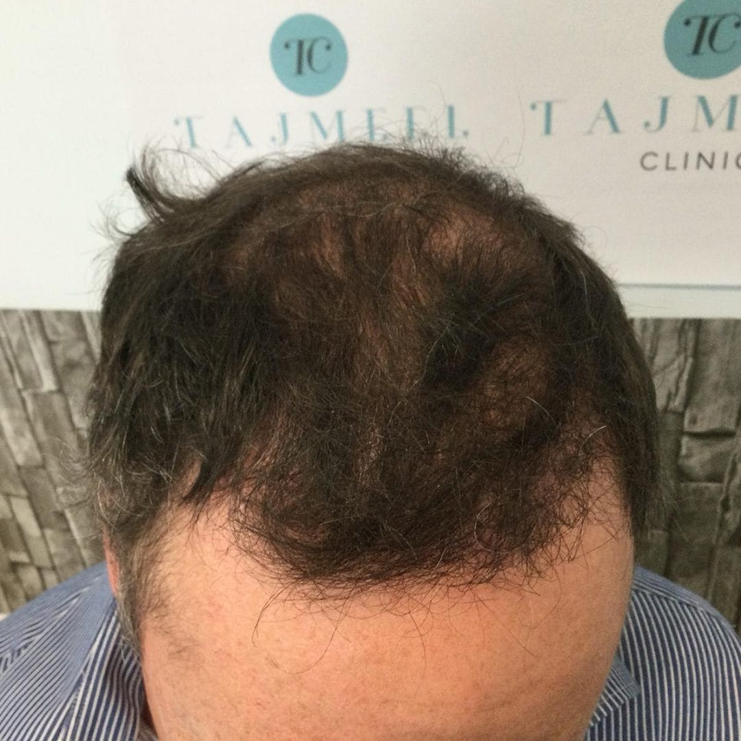 Hair transplant over 2 days , results after 7 months